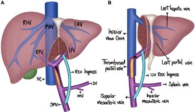 Technical Aspects and Considerations of Meso-Rex Bypass Following Liver Transplantation With Left Lateral Segment Grafts: Case Report and Review of the Literature